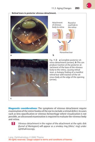 283
Retinal tears in posterior vitreous detachment.
Fig. 11.3 a Complete posterior vit-
reous detachment (arrows). b This can
produce traction at the posterior at-
tachment of the base of the vitreous
body to the retina, causing retinal
tears. c Autopsy finding of a manifest
retinal tear with traction of the vit-
reous body at the edge of the opening
(arrow).
Attachment
of vitreous
body to retina
Horseshoe tear
Round or
oval hole in
the retina
b
a b
c
Diagnostic considerations: The symptoms of vitreous detachment require
examination of the entire fundus of the eye to exclude a retinal defect. In cases
such as lens opacification or vitreous hemorrhage where visualization is not
possible, an ultrasound examination is required to evaluate the vitreous body
and retina.
Vitreous detachment in the region of the attachment at the optic disk
(funnel of Martegiani) will appear as a smokey ring (Weiss’ ring) under
ophthalmoscopy.
11.3 Aging Changes
Lang, Ophthalmology © 2000 Thieme
All rights reserved. Usage subject to terms and conditions of license.
 