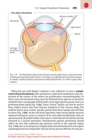 295
Pars plana vitrectomy.
Retina
Cerclage
(encircling
band)
Light source
Vitrectome
Infusion cannula
Fig. 11.7 The illustration depicts the infusion cannula, light source, and vitrectome
(cutting and aspirating instrument). A cerclage is usually placed around the equator
to release residual traction and prevent retinal detachment. It is left in place after
surgery.
Filling the eye with Ringer’s solution is not sufficient to treat a compli-
cated retinal detachment with epiretinal or subretinal membranes and con-
traction of the surface of the retina (see proliferative vitreoretinopathy). In
these cases, the detached retina must be flattened from anterior to posterior
and held with a tamponade of fluid with a very high specific gravity such as a
perfluorocarbon liquid (Fig. 11.8a). These “heavy” liquids can also be used to
float artifical lenses that have become displaced in the vitreous body. The
artificial lenses have a lower specific gravity than these liquids and will float
on them (Fig. 11.8b). At the end of the operation, these heavy liquids must be
replaced with gases, such as a mixture of air and sulfur hexafluoride, that are
spontaneously absorbed within a few days or with silicone oil (which must be
removed in a second operation). Postoperative patient positioning should
reflect the fact that maximum gas pressure will be in the superior region
(Fig. 11.9a) due to its buoyancy. Complicated retinal detachments will require
a prolonged internal tamponade. Silicone oil has proven effective for this pur-
11.6 Surgical Treatment: Vitrectomy
Lang, Ophthalmology © 2000 Thieme
All rights reserved. Usage subject to terms and conditions of license.
 