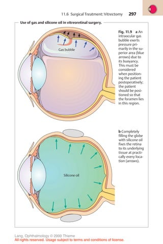 297
Use of gas and silicone oil in vitreoretinal surgery.
Fig. 11.9 a An
intraocular gas
bubble exerts
pressure pri-
marily in the su-
perior area (blue
arrows) due to
its buoyancy.
This must be
considered
when position-
ing the patient
postoperatively;
the patient
should be posi-
tioned so that
the foramen lies
in this region.
b Completely
filling the globe
with silicone oil
fixes the retina
to its underlying
tissue at practi-
cally every loca-
tion (arrows).
Gas bubble
Silicone oil
11.6 Surgical Treatment: Vitrectomy
Lang, Ophthalmology © 2000 Thieme
All rights reserved. Usage subject to terms and conditions of license.
 