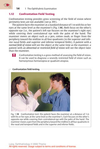 14
Confrontation field testing.
Fig. 1.14 Confrontation test: the patient faces the examiner at a distance of 1 m
with his or her eyes at the same level as the examiner’s. Each focuses on the other’s
opposite eye while covering their contralateral eye with the palm of the hand. The
examiner moves a pen from the periphery toward the midline in all four quadrants in
the nasal and temporal fields and in the superior and inferior fields.
1 The Ophthalmic Examination
1.12 Confrontation Field Testing
Confrontation testing provides gross screening of the field of vision where
perimetry tests are not available (see p. 391).
The patient faces the examiner at a standard distance of 1 m with his or her
eyes at the same level as the examiner’s (Fig. 1.14). Both focus on the other’s
opposite eye (i.e., the patient’s left eye focuses on the examiner’s right eye)
while covering their contralateral eye with the palm of the hand. The
examiner moves an object such as a pen, cotton swab, or finger from the
periphery toward the midline in all four quadrants (in the superior and infe-
rior nasal fields and superior and inferior temporal fields). A patient with a
normal field of vision will see the object at the same time as the examiner; a
patient with an abnormal or restricted field of vision will see the object later
than the examiner.
Confrontation testing is a gross method of assessing the field of vision.
It can be used to diagnose a severely restricted field of vision such as
homonymous hemianopsia or quadrant anopsia.
Lang, Ophthalmology © 2000 Thieme
All rights reserved. Usage subject to terms and conditions of license.
 