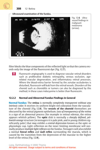 308
Ultrasound examination of the fundus.
Fig. 12.6 Ultra-
sound findings in
malignant
melanoma
(arrow).
filter blocks the blue components of the reflected light so that the camera rec-
ords only the image of the fluorescent dye (Fig. 12.7).
Fluorescein angiography is used to diagnose vascular retinal disorders
such as proliferative diabetic retinopathy, venous occlusion, age-
related macular degeneration, and inflammatory retinal processes.
Where the blood-retina barrier formed by the zonulae occludentes is
disturbed, fluorescein will leak from the retinal vessels. Disorders of the
choroid such as choroiditis or tumors can also be diagnosed by this
method; in these cases indocyanine is better than fluorescein.
12.2.2 Normal and Abnormal Fundus Findings in General
Normal fundus: The retina is normally completely transparent without any
intrinsic color. It receives its uniform bright red coloration from the vascula-
ture of the choroid (Fig. 12.8). The vessels of the choroid themselves are
obscured by the retinal pigment epithelium. Loss of transparency of the retina
is a sign of an abnormal process (for example in retinal edemas, the retina
appears whitish yellow). The optic disk is normally a sharply defined, yel-
lowish orange structure (in teenagers it is pale pink, and in young children sig-
nificantly paler) that may exhibit a central depression known as the optic or
physiologic cup. Light reflection on the inner limiting membrane will nor-
mally produce multiple light reflexes on the fundus. Teenagers will also exhibit
a normal foveal reflex and wall reflex surrounding the macula, which is
caused by the transition from the depression of the macular to the higher
level of the retina (Fig. 12.9).
12 Retina
Lang, Ophthalmology © 2000 Thieme
All rights reserved. Usage subject to terms and conditions of license.
 
