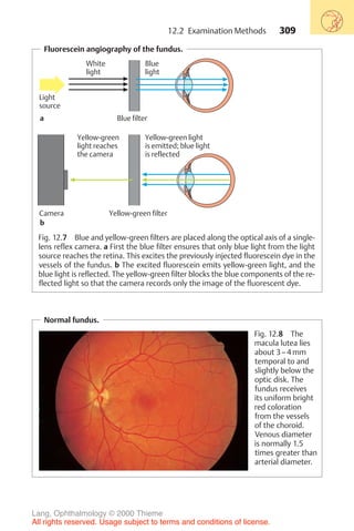309
Fluorescein angiography of the fundus.
White
light
Blue
light
Yellow-green
light reaches
the camera
Yellow-green light
is emitted; blue light
is reflected
Light
source
a Blue filter
Yellow-green filter
Camera
b
Fig. 12.7 Blue and yellow-green filters are placed along the optical axis of a single-
lens reflex camera. a First the blue filter ensures that only blue light from the light
source reaches the retina. This excites the previously injected fluorescein dye in the
vessels of the fundus. b The excited fluorescein emits yellow-green light, and the
blue light is reflected. The yellow-green filter blocks the blue components of the re-
flected light so that the camera records only the image of the fluorescent dye.
Normal fundus.
Fig. 12.8 The
macula lutea lies
about 3–4 mm
temporal to and
slightly below the
optic disk. The
fundus receives
its uniform bright
red coloration
from the vessels
of the choroid.
Venous diameter
is normally 1.5
times greater than
arterial diameter.
12.2 Examination Methods
Lang, Ophthalmology © 2000 Thieme
All rights reserved. Usage subject to terms and conditions of license.
 