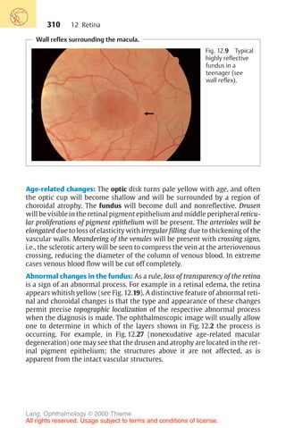 310
Wall reflex surrounding the macula.
Fig. 12.9 Typical
highly reflective
fundus in a
teenager (see
wall reflex).
Age-related changes: The optic disk turns pale yellow with age, and often
the optic cup will become shallow and will be surrounded by a region of
choroidal atrophy. The fundus will become dull and nonreflective. Drusen
will be visible in the retinal pigment epithelium and middle peripheral reticu-
lar proliferations of pigment epithelium will be present. The arterioles will be
elongated due to loss of elasticity with irregular filling due to thickening of the
vascular walls. Meandering of the venules will be present with crossing signs,
i.e., the sclerotic artery will be seen to compress the vein at the arteriovenous
crossing, reducing the diameter of the column of venous blood. In extreme
cases venous blood flow will be cut off completely.
Abnormal changes in the fundus: As a rule, loss of transparency of the retina
is a sign of an abnormal process. For example in a retinal edema, the retina
appears whitish yellow (see Fig. 12.19). A distinctive feature of abnormal reti-
nal and choroidal changes is that the type and appearance of these changes
permit precise topographic localization of the respective abnormal process
when the diagnosis is made. The ophthalmoscopic image will usually allow
one to determine in which of the layers shown in Fig. 12.2 the process is
occurring. For example, in Fig. 12.27 (nonexudative age-related macular
degeneration) one may see that the drusen and atrophy are located in the ret-
inal pigment epithelium; the structures above it are not affected, as is
apparent from the intact vascular structures.
12 Retina
Lang, Ophthalmology © 2000 Thieme
All rights reserved. Usage subject to terms and conditions of license.
 