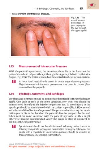 15
1.14 Eyedrops, Ointment, and Bandages
Measurement of intraocular pressure.
Fig. 1.15 The
examiner uses
both index fin-
gers to palpate
the eye through
the upper eyelid.
1.13 Measurement of Intraocular Pressure
With the patient’s eyes closed, the examiner places his or her hands on the
patient’s head and palpates the eye through the upper eyelid with both index
fingers (Fig. 1.15). The test is repeated on the contralateral eye for comparison.
A “rock hard” eyeball only occurs in acute angle closure glaucoma.
Slight increases in intraocular pressure such as occur in chronic glau-
coma will not be palpable.
1.14 Eyedrops, Ointment, and Bandages
Eyedrops and ointment should be administered posterior to the everted lower
eyelid. One drop or strip of ointment approximately 1 cm long should be
administered laterally to the inferior conjunctival sac. To avoid injury to the
eye, drops should be administered with the patient supine (Fig. 1.16) or seated
with the head tilted back and supported. The person administering the medi-
cation places his or her hand on the patient’s face for support. Bottles and
tubes must not come in contact with the patient’s eyelashes as they might
otherwise become contaminated. Allow the drops or strip of ointment to
drop into the conjunctival sac.
Eye ointment should not be administered following ocular trauma as
this may complicate subsequent examination or surgery. Dilation of the
pupils with a mydriatic in unconscious patients should be avoided as
this complicates neurologic examination.
Lang, Ophthalmology © 2000 Thieme
All rights reserved. Usage subject to terms and conditions of license.
 