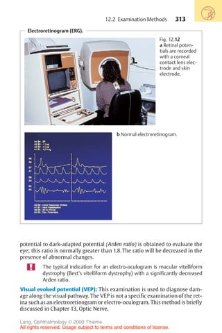 313
Electroretinogram (ERG).
Fig. 12.12
a Retinal poten-
tials are recorded
with a corneal
contact lens elec-
trode and skin
electrode.
b Normal electroretinogram.
potential to dark-adapted potential (Arden ratio) is obtained to evaluate the
eye; this ratio is normally greater than 1.8. The ratio will be decreased in the
presence of abnormal changes.
The typical indication for an electro-oculogram is macular vitelliform
dystrophy (Best’s vitelliform dystrophy) with a significantly decreased
Arden ratio.
Visual evoked potential (VEP): This examination is used to diagnose dam-
age along the visual pathway. The VEP is not a specific examination of the ret-
ina such as an electroretinogram or electro-oculogram. This method is briefly
discussed in Chapter 13, Optic Nerve.
12.2 Examination Methods
Lang, Ophthalmology © 2000 Thieme
All rights reserved. Usage subject to terms and conditions of license.
 