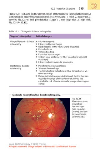 315
Table 12.1 Changes in diabetic retinopathy
Stage of retinopathy Retinal changes
Nonproliferative diabetic
retinopathy
❖ Microaneurysms.
❖ Intraretinal hemorrhages
❖ Lipid deposits in the retina (hard exudates)
❖ Retinal edema
❖ Venous beading
❖ Excessive hemorrhages
❖ Cotton-wool spots (nerve fiber infarctions with soft
exudates)
❖ Intraretinal microvascular anomalies
Proliferative diabetic
retinopathy
❖ Preretinal neovascularization
❖ Vitreous hemorrhage
❖ Tractional retinal detachment (due to traction of vit-
reous scarring)
❖ Rubeosis iridis (neovascularization of the iris that can
occlude the angle of the anterior chamber; this
entails the risk of acute secondary angle closure glau-
coma)
(Table 12.1) is based on the classification of the Diabetic Retinopathy Study. A
distinction is made between nonproliferative stages (1. mild, 2. moderate, 3.
severe; Fig. 12.14) and proliferative stages (1. non-high-risk 2. high-risk;
Fig. 12.15–12.17).
Moderate nonproliferative diabetic retinopathy.
Fig. 12.14
Microaneurysms,
intraretinal
hemorrhages,
hard exudates
(arrow), and cot-
ton-wool spots
(arrowheads).
12.3 Vascular Disorders
Lang, Ophthalmology © 2000 Thieme
All rights reserved. Usage subject to terms and conditions of license.
 