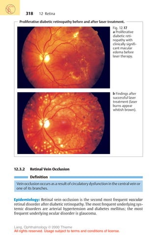 318
Proliferative diabetic retinopathy before and after laser treatment.
Fig. 12.17
a Proliferative
diabetic reti-
nopathy with
clinically signifi-
cant macular
edema before
laser therapy.
b Findings after
successful laser
treatment (laser
burns appear
whitish brown).
12.3.2 Retinal Vein Occlusion
Definition
Vein occlusion occurs as a result of circulatory dysfunction in the central vein or
one of its branches.
Epidemiology: Retinal vein occlusion is the second most frequent vascular
retinal disorder after diabetic retinopathy. The most frequent underlying sys-
temic disorders are arterial hypertension and diabetes mellitus; the most
frequent underlying ocular disorder is glaucoma.
12 Retina
Lang, Ophthalmology © 2000 Thieme
All rights reserved. Usage subject to terms and conditions of license.
 