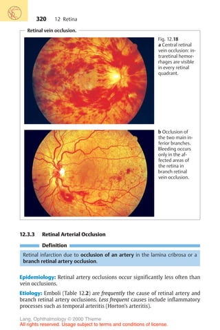 320
12.3.3 Retinal Arterial Occlusion
Definition
Retinal infarction due to occlusion of an artery in the lamina cribrosa or a
branch retinal artery occlusion.
Epidemiology: Retinal artery occlusions occur significantly less often than
vein occlusions.
Etiology: Emboli (Table 12.2) are frequently the cause of retinal artery and
branch retinal artery occlusions. Less frequent causes include inflammatory
processes such as temporal arteritis (Horton’s arteritis).
Retinal vein occlusion.
Fig. 12.18
a Central retinal
vein occlusion: in-
traretinal hemor-
rhages are visible
in every retinal
quadrant.
b Occlusion of
the two main in-
ferior branches.
Bleeding occurs
only in the af-
fected areas of
the retina in
branch retinal
vein occlusion.
12 Retina
Lang, Ophthalmology © 2000 Thieme
All rights reserved. Usage subject to terms and conditions of license.
 