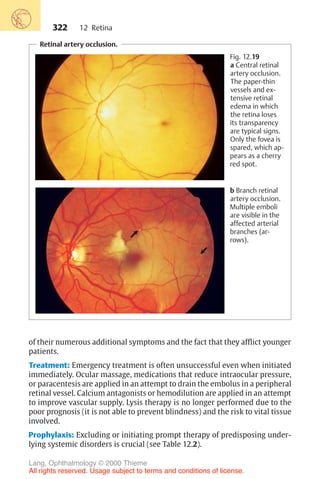 322
Retinal artery occlusion.
Fig. 12.19
a Central retinal
artery occlusion.
The paper-thin
vessels and ex-
tensive retinal
edema in which
the retina loses
its transparency
are typical signs.
Only the fovea is
spared, which ap-
pears as a cherry
red spot.
b Branch retinal
artery occlusion.
Multiple emboli
are visible in the
affected arterial
branches (ar-
rows).
of their numerous additional symptoms and the fact that they afflict younger
patients.
Treatment: Emergency treatment is often unsuccessful even when initiated
immediately. Ocular massage, medications that reduce intraocular pressure,
or paracentesis are applied in an attempt to drain the embolus in a peripheral
retinal vessel. Calcium antagonists or hemodilution are applied in an attempt
to improve vascular supply. Lysis therapy is no longer performed due to the
poor prognosis (it is not able to prevent blindness) and the risk to vital tissue
involved.
Prophylaxis: Excluding or initiating prompt therapy of predisposing under-
lying systemic disorders is crucial (see Table 12.2).
12 Retina
Lang, Ophthalmology © 2000 Thieme
All rights reserved. Usage subject to terms and conditions of license.
 