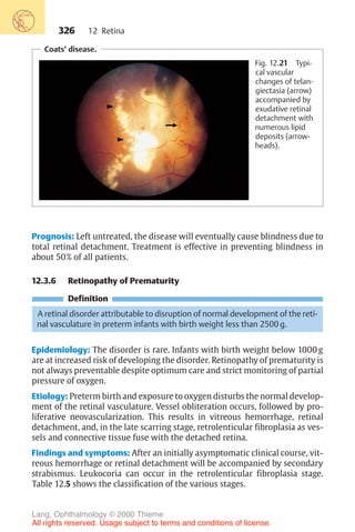 326
Coats’ disease.
Fig. 12.21 Typi-
cal vascular
changes of telan-
giectasia (arrow)
accompanied by
exudative retinal
detachment with
numerous lipid
deposits (arrow-
heads).
Prognosis: Left untreated, the disease will eventually cause blindness due to
total retinal detachment. Treatment is effective in preventing blindness in
about 50% of all patients.
12.3.6 Retinopathy of Prematurity
Definition
A retinal disorder attributable to disruption of normal development of the reti-
nal vasculature in preterm infants with birth weight less than 2500 g.
Epidemiology: The disorder is rare. Infants with birth weight below 1000 g
are at increased risk of developing the disorder. Retinopathy of prematurity is
not always preventable despite optimum care and strict monitoring of partial
pressure of oxygen.
Etiology: Preterm birth and exposure to oxygen disturbs the normal develop-
ment of the retinal vasculature. Vessel obliteration occurs, followed by pro-
liferative neovascularization. This results in vitreous hemorrhage, retinal
detachment, and, in the late scarring stage, retrolenticular fibroplasia as ves-
sels and connective tissue fuse with the detached retina.
Findings and symptoms: After an initially asymptomatic clinical course, vit-
reous hemorrhage or retinal detachment will be accompanied by secondary
strabismus. Leukocoria can occur in the retrolenticular fibroplasia stage.
Table 12.5 shows the classification of the various stages.
12 Retina
Lang, Ophthalmology © 2000 Thieme
All rights reserved. Usage subject to terms and conditions of license.
 