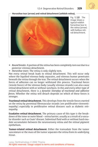 329
Horseshoe tear (arrow) and retinal detachment (whitish retina).
Fig. 12.22 The
image shows a
typical reddish
horseshoe tear in
the retina (arrow)
with bullous reti-
nal detachment.
❖ Round breaks: A portion of the retina has been completely torn out due to a
posterior vitreous detachment.
❖ Horseshoe tears: The retina is only slightly torn.
Not every retinal break leads to retinal detachment. This will occur only
where the liquified vitreous body separates, and vitreous humor penetrates
beneath the retina through the tear. The retinal detachment occurs when the
forces of adhesion can no longer withstand this process. Tractional forces
(tensile forces) of the vitreous body (usually vitreous strands) can also cause
retinal detachment with or without synchysis. In this and every other type of
retinal detachment, there is a dynamic interplay of tractional and adhesive
forces. Whether the retina will detach depends on which of these forces is
stronger.
Tractional retinal detachment. This develops from the tensile forces exerted
on the retina by preretinal fibrovascular strands (see proliferative vitreoreti-
nopathy) especially in proliferative retinal diseases such as diabetic reti-
nopathy.
Exudative retinal detachment. The primary cause of this type is the break-
down of the inner or outer blood – retina barrier, usually as a result of a vascu-
lar disorder such as Coats’ disease. Subretinal fluid with or without hard exu-
date accumulates between the neurosensory retina and the retinal pigment
epithelium.
Tumor-related retinal detachment. Either the transudate from the tumor
vasculature or the mass of the tumor separates the retina from its underlying
tissue.
12.4 Degenerative Retinal Disorders
Lang, Ophthalmology © 2000 Thieme
All rights reserved. Usage subject to terms and conditions of license.
 