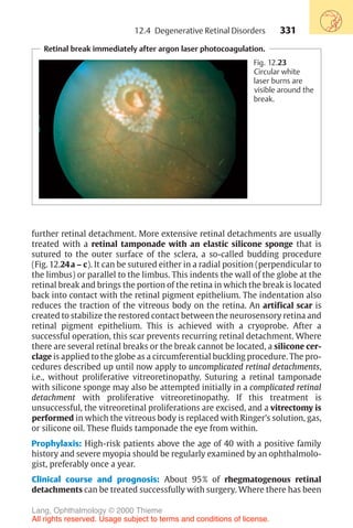 331
Retinal break immediately after argon laser photocoagulation.
Fig. 12.23
Circular white
laser burns are
visible around the
break.
further retinal detachment. More extensive retinal detachments are usually
treated with a retinal tamponade with an elastic silicone sponge that is
sutured to the outer surface of the sclera, a so-called budding procedure
(Fig. 12.24a – c). It can be sutured either in a radial position (perpendicular to
the limbus) or parallel to the limbus. This indents the wall of the globe at the
retinal break and brings the portion of the retina in which the break is located
back into contact with the retinal pigment epithelium. The indentation also
reduces the traction of the vitreous body on the retina. An artifical scar is
created to stabilize the restored contact between the neurosensory retina and
retinal pigment epithelium. This is achieved with a cryoprobe. After a
successful operation, this scar prevents recurring retinal detachment. Where
there are several retinal breaks or the break cannot be located, a silicone cer-
clage is applied to the globe as a circumferential buckling procedure. The pro-
cedures described up until now apply to uncomplicated retinal detachments,
i.e., without proliferative vitreoretinopathy. Suturing a retinal tamponade
with silicone sponge may also be attempted initially in a complicated retinal
detachment with proliferative vitreoretinopathy. If this treatment is
unsuccessful, the vitreoretinal proliferations are excised, and a vitrectomy is
performed in which the vitreous body is replaced with Ringer’s solution, gas,
or silicone oil. These fluids tamponade the eye from within.
Prophylaxis: High-risk patients above the age of 40 with a positive family
history and severe myopia should be regularly examined by an ophthalmolo-
gist, preferably once a year.
Clinical course and prognosis: About 95% of rhegmatogenous retinal
detachments can be treated successfully with surgery. Where there has been
12.4 Degenerative Retinal Disorders
Lang, Ophthalmology © 2000 Thieme
All rights reserved. Usage subject to terms and conditions of license.
 