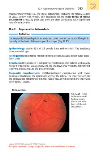 333
macular involvement (i.e., the initial detachment included the macula), a loss
of visual acuity will remain. The prognosis for the other forms of retinal
detachment is usually poor, and they are often associated with significant
loss of visual acuity.
12.4.2 Degenerative Retinoschisis
Definition
A frequently bilateral split in an inner and outer layer of the retina. The split is
usually at the level of the outer plexiform layer (Fig. 12.25).
Epidemiology: About 25% of all people have retinoschisis. The tendency
increases with age.
Pathogenesis: Idiopathic retinal splitting occurs, usually in the outer plexi-
form layer.
Symptoms: Retinoschisis is primarily asymptomatic. The patient will usually
notice a reduction of visual acuity and see shadows only when the retinal split
is severe and extends to the posterior pole.
Diagnostic considerations: Ophthalmoscopic examination will reveal
bullous separation of the split inner layer of the retina. The inner surface has
the appearance of hammered metal. Rarely breaks will occur in the inner and
outer retinal layers.
Retinoschisis.
Fig. 12.25 Split
in the retina with
bullous separa-
tion of the inner
layers of the ret-
ina (arrows).
12.4 Degenerative Retinal Disorders
Lang, Ophthalmology © 2000 Thieme
All rights reserved. Usage subject to terms and conditions of license.
 