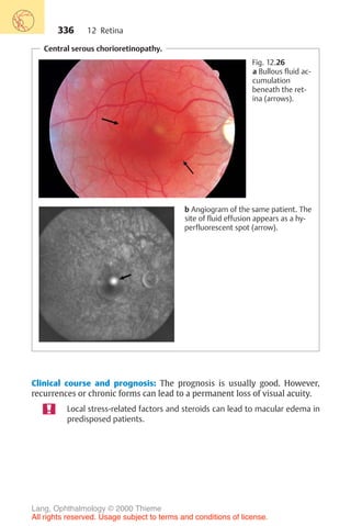336
Central serous chorioretinopathy.
Fig. 12.26
a Bullous fluid ac-
cumulation
beneath the ret-
ina (arrows).
b Angiogram of the same patient. The
site of fluid effusion appears as a hy-
perfluorescent spot (arrow).
Clinical course and prognosis: The prognosis is usually good. However,
recurrences or chronic forms can lead to a permanent loss of visual acuity.
Local stress-related factors and steroids can lead to macular edema in
predisposed patients.
12 Retina
Lang, Ophthalmology © 2000 Thieme
All rights reserved. Usage subject to terms and conditions of license.
 