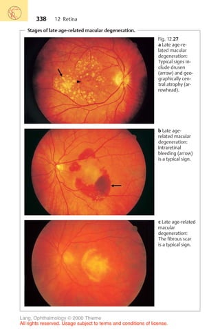 338
Stages of late age-related macular degeneration.
Fig. 12.27
a Late age-re-
lated macular
degeneration:
Typical signs in-
clude drusen
(arrow) and geo-
graphically cen-
tral atrophy (ar-
rowhead).
b Late age-
related macular
degeneration:
Intraretinal
bleeding (arrow)
is a typical sign.
c Late age-related
macular
degeneration:
The fibrous scar
is a typical sign.
12 Retina
Lang, Ophthalmology © 2000 Thieme
All rights reserved. Usage subject to terms and conditions of license.
 
