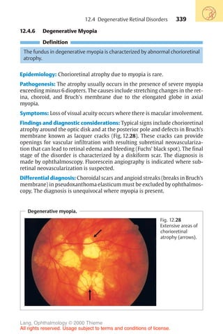 339
12.4.6 Degenerative Myopia
Definition
The fundus in degenerative myopia is characterized by abnormal chorioretinal
atrophy.
Epidemiology: Chorioretinal atrophy due to myopia is rare.
Pathogenesis: The atrophy usually occurs in the presence of severe myopia
exceeding minus 6 diopters. The causes include stretching changes in the ret-
ina, choroid, and Bruch's membrane due to the elongated globe in axial
myopia.
Symptoms: Loss of visual acuity occurs where there is macular involvement.
Findings and diagnostic considerations: Typical signs include chorioretinal
atrophy around the optic disk and at the posterior pole and defects in Bruch’s
membrane known as lacquer cracks (Fig. 12.28). These cracks can provide
openings for vascular infiltration with resulting subretinal neovasculariza-
tion that can lead to retinal edema and bleeding (Fuchs’ black spot). The final
stage of the disorder is characterized by a diskiform scar. The diagnosis is
made by ophthalmoscopy. Fluorescein angiography is indicated where sub-
retinal neovascularization is suspected.
Differential diagnosis: Choroidal scars and angioid streaks (breaks in Bruch’s
membrane) in pseudoxanthoma elasticum must be excluded by ophthalmos-
copy. The diagnosis is unequivocal where myopia is present.
Degenerative myopia.
Fig. 12.28
Extensive areas of
chorioretinal
atrophy (arrows).
12.4 Degenerative Retinal Disorders
Lang, Ophthalmology © 2000 Thieme
All rights reserved. Usage subject to terms and conditions of license.
 
