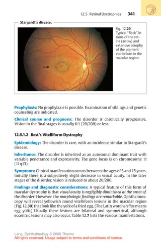 341
Stargardt’s disease.
Fig. 12.29
Typical “fleck” le-
sions of the ret-
ina (arrow) and
extensive atrophy
of the pigment
epithelium in the
macular region.
Prophylaxis: No prophylaxis is possible. Examination of siblings and genetic
counseling are indicated.
Clinical course and prognosis: The disorder is chronically progressive.
Vision in the final stages is usually 0.1 (20/200) or less.
12.5.1.2 Best’s Vitelliform Dystrophy
Epidemiology: The disorder is rare, with an incidence similar to Stargardt’s
disease.
Inheritance: The disorder is inherited as an autosomal dominant trait with
variable penetrance and expressivity. The gene locus is on chromosome 11
(11q13).
Symptoms: Clinical manifestation occurs between the ages of 5 and 15 years.
Initially there is a subjectively slight decrease in visual acuity. In the later
stages of the disorder, vision is reduced to about 20/200.
Findings and diagnostic considerations: A typical feature of this form of
macular dystrophy is that visual acuity is negligibly diminished at the onset of
the disorder. However, the morphologic findings are remarkable. Ophthalmos-
copy will reveal yellowish round vitelliform lesions in the macular region
(Fig. 12.30) that look like the yolk of a fried egg. (The Latin word vitellus means
egg yolk.) Usually these lesions are bilateral and symmetrical, although
eccentric lesions may also occur. Table 12.7 lists the various manifestations.
12.5 Retinal Dystrophies
Lang, Ophthalmology © 2000 Thieme
All rights reserved. Usage subject to terms and conditions of license.
 