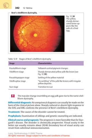 342
Best’s vitelliform dystrophy.
Fig. 12.30
The yellow,
sharply demar-
cated lesion ap-
pears like the
yolk of a fried
egg.
Table 12.7 Stages of Best’s vitelliform dystrophy
Stage Characteristics
Previtelliform stage Yellowish central pigment changes
Vitelliform stage Sharply demarcated yellow yolk-like lesion (see
Fig. 12.30)
Pseudohypopyon stage Settling of the yellow material
Vitelliruptive stage “Scrambling” of the yolk-like lesions with irregular
yellow deposits
Scar stage Transition to scar
The macular change resembling an egg yolk gave rise to the name vitel-
liform dystrophy.
Differential diagnosis: An unequivocal diagnosis can usually be made on the
basis of the clinical picture alone. Sharply reduced or absent light response in
the EOG and ERG confirms the presence of Best’s vitelliform dystrophy.
Treatment: The causes of the disorder cannot be treated.
Prophylaxis: Examination of siblings and genetic counseling are indicated.
Clinical course and prognosis: The prognosis is more favorable than for Star-
gardt’s disease. The disorder is chronically progressive. Visual acuity in the
better eye usually remains about 20/40. Secondary loss of visual acuity can
result from subretinal neovascularization.
12 Retina
Lang, Ophthalmology © 2000 Thieme
All rights reserved. Usage subject to terms and conditions of license.
 