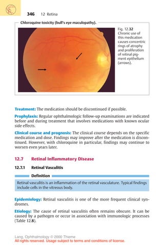 346
Chloroquine toxicity (bull’s eye maculopathy).
Fig. 12.32
Chronic use of
this medication
causes concentric
rings of atrophy
and proliferation
of retinal pig-
ment epithelium
(arrows).
Treatment: The medication should be discontinued if possible.
Prophylaxis: Regular ophthalmologic follow-up examinations are indicated
before and during treatment that involves medications with known ocular
side effects.
Clinical course and prognosis: The clinical course depends on the specific
medication and dose. Findings may improve after the medication is discon-
tinued. However, with chloroquine in particular, findings may continue to
worsen even years later.
12.7 Retinal Inflammatory Disease
12.7.1 Retinal Vasculitis
Definition
Retinal vasculitis is an inflammation of the retinal vasculature. Typical findings
include cells in the vitreous body.
Epidemiology: Retinal vasculitis is one of the more frequent clinical syn-
dromes.
Etiology: The cause of retinal vasculitis often remains obscure. It can be
caused by a pathogen or occur in association with immunologic processes
(Table 12.8).
12 Retina
Lang, Ophthalmology © 2000 Thieme
All rights reserved. Usage subject to terms and conditions of license.
 