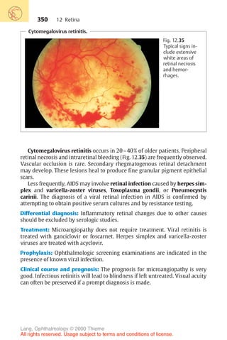 350
Cytomegalovirus retinitis occurs in 20–40% of older patients. Peripheral
retinal necrosis and intraretinal bleeding (Fig. 12.35) are frequently observed.
Vascular occlusion is rare. Secondary rhegmatogenous retinal detachment
may develop. These lesions heal to produce fine granular pigment epithelial
scars.
Less frequently, AIDS may involve retinal infection caused by herpes sim-
plex and varicella-zoster viruses, Toxoplasma gondii, or Pneumocystis
carinii. The diagnosis of a viral retinal infection in AIDS is confirmed by
attempting to obtain positive serum cultures and by resistance testing.
Differential diagnosis: Inflammatory retinal changes due to other causes
should be excluded by serologic studies.
Treatment: Microangiopathy does not require treatment. Viral retinitis is
treated with ganciclovir or foscarnet. Herpes simplex and varicella-zoster
viruses are treated with acyclovir.
Prophylaxis: Ophthalmologic screening examinations are indicated in the
presence of known viral infection.
Clinical course and prognosis: The prognosis for microangiopathy is very
good. Infectious retinitis will lead to blindness if left untreated. Visual acuity
can often be preserved if a prompt diagnosis is made.
Cytomegalovirus retinitis.
Fig. 12.35
Typical signs in-
clude extensive
white areas of
retinal necrosis
and hemor-
rhages.
12 Retina
Lang, Ophthalmology © 2000 Thieme
All rights reserved. Usage subject to terms and conditions of license.
 
