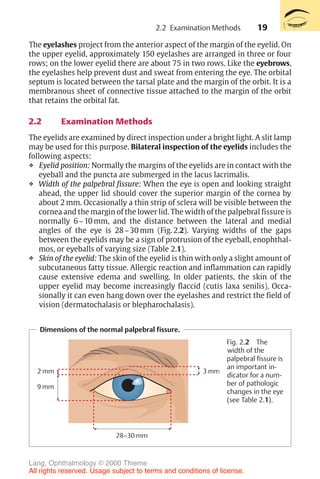 19
Dimensions of the normal palpebral fissure.
2 mm
9 mm
28–30 mm
3 mm
Fig. 2.2 The
width of the
palpebral fissure is
an important in-
dicator for a num-
ber of pathologic
changes in the eye
(see Table 2.1).
The eyelashes project from the anterior aspect of the margin of the eyelid. On
the upper eyelid, approximately 150 eyelashes are arranged in three or four
rows; on the lower eyelid there are about 75 in two rows. Like the eyebrows,
the eyelashes help prevent dust and sweat from entering the eye. The orbital
septum is located between the tarsal plate and the margin of the orbit. It is a
membranous sheet of connective tissue attached to the margin of the orbit
that retains the orbital fat.
2.2 Examination Methods
The eyelids are examined by direct inspection under a bright light. A slit lamp
may be used for this purpose. Bilateral inspection of the eyelids includes the
following aspects:
❖ Eyelid position: Normally the margins of the eyelids are in contact with the
eyeball and the puncta are submerged in the lacus lacrimalis.
❖ Width of the palpebral fissure: When the eye is open and looking straight
ahead, the upper lid should cover the superior margin of the cornea by
about 2 mm. Occasionally a thin strip of sclera will be visible between the
cornea and the margin of the lower lid. The width of the palpebral fissure is
normally 6–10 mm, and the distance between the lateral and medial
angles of the eye is 28–30 mm (Fig. 2.2). Varying widths of the gaps
between the eyelids may be a sign of protrusion of the eyeball, enophthal-
mos, or eyeballs of varying size (Table 2.1).
❖ Skin of the eyelid: The skin of the eyelid is thin with only a slight amount of
subcutaneous fatty tissue. Allergic reaction and inflammation can rapidly
cause extensive edema and swelling. In older patients, the skin of the
upper eyelid may become increasingly flaccid (cutis laxa senilis). Occa-
sionally it can even hang down over the eyelashes and restrict the field of
vision (dermatochalasis or blepharochalasis).
2.2 Examination Methods
Lang, Ophthalmology © 2000 Thieme
All rights reserved. Usage subject to terms and conditions of license.
 