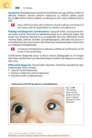354
Symptoms: Retinoblastoma manifests itself before the age of three in 90% of
affected children. Parents observe leukocoria (a whitish yellow pupil;
Fig. 12.36) in 60% of these children, strabismus in 20%, and a reddened eye in
10%.
Every child presenting with strabismus should undergo examination of
the fundus with the pupil dilated to exclude a retinoblastoma.
Findings and diagnostic considerations: A grayish white, vascularized reti-
nal tumor will be observed on ophthalmoscopy. In its advanced stages, this
tumor was formerly referred to as an amaurotic cat's eye. Infiltration of the
vitreous body, anterior chamber (pseudohypopyon), and orbit may occur. A
retinoblastoma that also involves the fellow eye and pineal body is referred to
as a trilateral retinoblastoma.
A trilateral retinoblastoma is defined as additional manifestation of the
tumor in the pineal body.
Calcifications frequently occur in these tumors. Radiographs or CT images
that show calcifications can therefore help to confirm the diagnosis in uncer-
tain cases.
Differential diagnosis: Several other disorders should be excluded by oph-
thalmoscopy. These include:
❖ Cataract (with leukocoria).
❖ Primary strabismus (with strabismus).
❖ Infection (with a reddened eye).
Leukocoria in the left eye due to a retinoblastoma.
Fig. 12.36
The whitish
gleam of the
pupil of the left
eye is a typical
finding in retino-
blastoma.
12 Retina
Lang, Ophthalmology © 2000 Thieme
All rights reserved. Usage subject to terms and conditions of license.
 