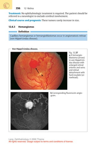 356
Treatment: No ophthalmologic treatment is required. The patient should be
referred to a neurologist to exclude cerebral involvement.
Clinical course and prognosis: These tumors rarely increase in size.
12.8.3 Hemangiomas
Definition
Capillary hemangiomas or hemangioblastomas occur in angiomatosis retinae
(von Hippel-Lindau disease).
12 Retina
Von Hippel-Lindau disease.
Fig. 12.37
a A hemangio-
blastoma (arrow)
in von Hippel-Lin-
dau disease with
enlarged retinal
arteries and veins
and retinal
detachment with
hard exudate (ar-
rowhead).
b Corresponding fluorescein angio-
gram.
Lang, Ophthalmology © 2000 Thieme
All rights reserved. Usage subject to terms and conditions of license.
 