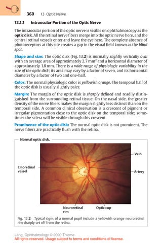 360
13.1.1 Intraocular Portion of the Optic Nerve
The intraocular portion of the optic nerve is visible on ophthalmoscopy as the
optic disk. All the retinal nerve fibers merge into the optic nerve here, and the
central retinal vessels enter and leave the eye here. The complete absence of
photoreceptors at this site creates a gap in the visual field known as the blind
spot.
Shape and size: The optic disk (Fig. 13.2) is normally slightly vertically oval
with an average area of approximately 2.7 mm2
and a horizontal diameter of
approximately 1.8 mm. There is a wide range of physiologic variability in the
size of the optic disk; its area may vary by a factor of seven, and its horizontal
diameter by a factor of two and one-half.
Color: The normal physiologic color is yellowish orange. The temporal half of
the optic disk is usually slightly paler.
Margin: The margin of the optic disk is sharply defined and readily distin-
guished from the surrounding retinal tissue. On the nasal side, the greater
density of the nerve fibers makes the margin slightly less distinct than on the
temporal side. A common clinical observation is a crescent of pigment or
irregular pigmentation close to the optic disk on the temporal side; some-
times the sclera will be visible through this crescent.
Prominence of the optic disk: The normal optic disk is not prominent. The
nerve fibers are practically flush with the retina.
Normal optic disk.
Cilioretinal
vessel
Vein
Artery
Optic cup
Neuroretinal
rim
Fig. 13.2 Typical signs of a normal pupil include a yellowish orange neuroretinal
rim sharply set off from the retina.
13 Optic Nerve
Lang, Ophthalmology © 2000 Thieme
All rights reserved. Usage subject to terms and conditions of license.
 
