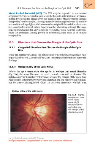 363
Visual Evoked Potential (VEP): The VEP may be regarded as an isolated
occipital EEG. The electrical responses in the brain to optical stimuli are trans-
mitted by electrodes placed over the occipital lobe. Measurements include
the speed of conduction (i.e., latency; normal values range between 90 and 110
ms) and the voltage differential between the occipital lobe and skin electrodes
(i.e., amplitude; normal values depend on the laboratory setting). The most
important indication for VEP testing is retrobulbar optic neuritis to demon-
strate an extended latency period in demyelinization, such as in diffuse
encephalitis.
13.3 Disorders that Obscure the Margin of the Optic Disk
13.3.1 Congenital Disorders that Obscure the Margin of the Optic
Disk
There are normal variants of the optic disk in which the margin appears fully
or partially blurred. Care should be taken to distinguish them from abnormal
findings.
13.3.1.1 Oblique Entry of the Optic Nerve
Where the optic nerve exits the eye in an oblique and nasal direction
(Fig. 13.4), the nerve fibers on the nasal circumference will be elevated. The
tightly compressed nasal nerve fibers will obscure the margin of the optic disk.
Accordingly, temporal nerve fibers are stretched, and the neuroretinal rim can-
not be clearly distinguished. Often an adjacent crescentic whitish area,
Oblique entry of the optic nerve.
Fig. 13.4 Tightly
compressed nasal
nerve fibers
cause slight
elevation of the
optic disk, and
the margin of the
disk is obscured.
13.3 Disorders that Obscure the Margin of the Optic Disk
Lang, Ophthalmology © 2000 Thieme
All rights reserved. Usage subject to terms and conditions of license.
 