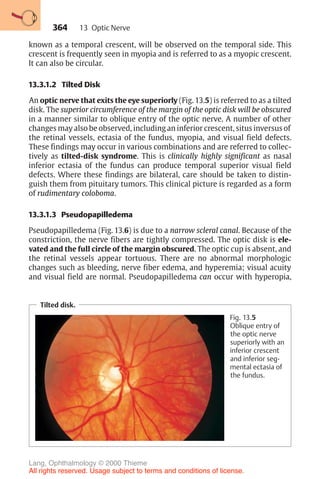 364
known as a temporal crescent, will be observed on the temporal side. This
crescent is frequently seen in myopia and is referred to as a myopic crescent.
It can also be circular.
13.3.1.2 Tilted Disk
An optic nerve that exits the eye superiorly (Fig. 13.5) is referred to as a tilted
disk. The superior circumference of the margin of the optic disk will be obscured
in a manner similar to oblique entry of the optic nerve. A number of other
changes may also be observed, including an inferior crescent, situs inversus of
the retinal vessels, ectasia of the fundus, myopia, and visual field defects.
These findings may occur in various combinations and are referred to collec-
tively as tilted-disk syndrome. This is clinically highly significant as nasal
inferior ectasia of the fundus can produce temporal superior visual field
defects. Where these findings are bilateral, care should be taken to distin-
guish them from pituitary tumors. This clinical picture is regarded as a form
of rudimentary coloboma.
13.3.1.3 Pseudopapilledema
Pseudopapilledema (Fig. 13.6) is due to a narrow scleral canal. Because of the
constriction, the nerve fibers are tightly compressed. The optic disk is ele-
vated and the full circle of the margin obscured. The optic cup is absent, and
the retinal vessels appear tortuous. There are no abnormal morphologic
changes such as bleeding, nerve fiber edema, and hyperemia; visual acuity
and visual field are normal. Pseudopapilledema can occur with hyperopia,
Tilted disk.
Fig. 13.5
Oblique entry of
the optic nerve
superiorly with an
inferior crescent
and inferior seg-
mental ectasia of
the fundus.
13 Optic Nerve
Lang, Ophthalmology © 2000 Thieme
All rights reserved. Usage subject to terms and conditions of license.
 