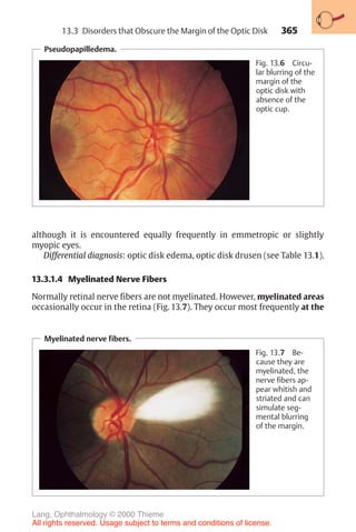 365
Pseudopapilledema.
Fig. 13.6 Circu-
lar blurring of the
margin of the
optic disk with
absence of the
optic cup.
although it is encountered equally frequently in emmetropic or slightly
myopic eyes.
Differential diagnosis: optic disk edema, optic disk drusen (see Table 13.1).
13.3.1.4 Myelinated Nerve Fibers
Normally retinal nerve fibers are not myelinated. However, myelinated areas
occasionally occur in the retina (Fig. 13.7). They occur most frequently at the
Myelinated nerve fibers.
Fig. 13.7 Be-
cause they are
myelinated, the
nerve fibers ap-
pear whitish and
striated and can
simulate seg-
mental blurring
of the margin.
13.3 Disorders that Obscure the Margin of the Optic Disk
Lang, Ophthalmology © 2000 Thieme
All rights reserved. Usage subject to terms and conditions of license.
 
