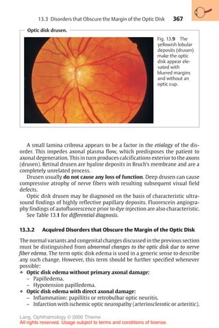 367
Optic disk drusen.
Fig. 13.9 The
yellowish lobular
deposits (drusen)
make the optic
disk appear ele-
vated with
blurred margins
and without an
optic cup.
A small lamina cribrosa appears to be a factor in the etiology of the dis-
order. This impedes axonal plasma flow, which predisposes the patient to
axonal degeneration. This in turn produces calcifications exterior to the axons
(drusen). Retinal drusen are hyaline deposits in Bruch’s membrane and are a
completely unrelated process.
Drusen usually do not cause any loss of function. Deep drusen can cause
compressive atrophy of nerve fibers with resulting subsequent visual field
defects.
Optic disk drusen may be diagnosed on the basis of characteristic ultra-
sound findings of highly reflective papillary deposits. Fluorescein angiogra-
phy findings of autofluorescence prior to dye injection are also characteristic.
See Table 13.1 for differential diagnosis.
13.3.2 Acquired Disorders that Obscure the Margin of the Optic Disk
The normal variants and congenital changes discussed in the previous section
must be distinguished from abnormal changes to the optic disk due to nerve
fiber edema. The term optic disk edema is used in a generic sense to describe
any such change. However, this term should be further specified whenever
possible:
❖ Optic disk edema without primary axonal damage:
– Papilledema.
– Hypotension papilledema.
❖ Optic disk edema with direct axonal damage:
– Inflammation: papillitis or retrobulbar optic neuritis.
– Infarction with ischemic optic neuropathy (arteriosclerotic or arteritic).
13.3 Disorders that Obscure the Margin of the Optic Disk
Lang, Ophthalmology © 2000 Thieme
All rights reserved. Usage subject to terms and conditions of license.
 