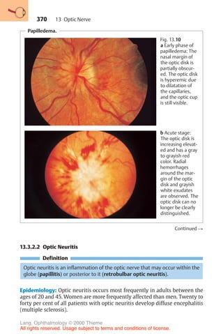 370
Papilledema.
Fig. 13.10
a Early phase of
papilledema: The
nasal margin of
the optic disk is
partially obscur-
ed. The optic disk
is hyperemic due
to dilatation of
the capillaries,
and the optic cup
is still visible.
b Acute stage:
The optic disk is
increasing elevat-
ed and has a gray
to grayish red
color. Radial
hemorrhages
around the mar-
gin of the optic
disk and grayish
white exudates
are observed. The
optic disk can no
longer be clearly
distinguished.
Continued !
13.3.2.2 Optic Neuritis
Definition
Optic neuritis is an inflammation of the optic nerve that may occur within the
globe (papillitis) or posterior to it (retrobulbar optic neuritis).
Epidemiology: Optic neuritis occurs most frequently in adults between the
ages of 20 and 45. Women are more frequently affected than men. Twenty to
forty per cent of all patients with optic neuritis develop diffuse encephalitis
(multiple sclerosis).
13 Optic Nerve
Lang, Ophthalmology © 2000 Thieme
All rights reserved. Usage subject to terms and conditions of license.
 