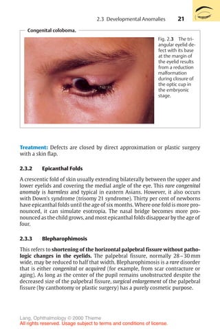 21
Treatment: Defects are closed by direct approximation or plastic surgery
with a skin flap.
2.3.2 Epicanthal Folds
A crescentic fold of skin usually extending bilaterally between the upper and
lower eyelids and covering the medial angle of the eye. This rare congenital
anomaly is harmless and typical in eastern Asians. However, it also occurs
with Down’s syndrome (trisomy 21 syndrome). Thirty per cent of newborns
have epicanthal folds until the age of six months. Where one fold is more pro-
nounced, it can simulate esotropia. The nasal bridge becomes more pro-
nounced as the child grows, and most epicanthal folds disappear by the age of
four.
2.3.3 Blepharophimosis
This refers to shortening of the horizontal palpebral fissure without patho-
logic changes in the eyelids. The palpebral fissure, normally 28–30 mm
wide, may be reduced to half that width. Blepharophimosis is a rare disorder
that is either congenital or acquired (for example, from scar contracture or
aging). As long as the center of the pupil remains unobstructed despite the
decreased size of the palpebral fissure, surgical enlargement of the palpebral
fissure (by canthotomy or plastic surgery) has a purely cosmetic purpose.
Congenital coloboma.
Fig. 2.3 The tri-
angular eyelid de-
fect with its base
at the margin of
the eyelid results
from a reduction
malformation
during closure of
the optic cup in
the embryonic
stage.
2.3 Developmental Anomalies
Lang, Ophthalmology © 2000 Thieme
All rights reserved. Usage subject to terms and conditions of license.
 