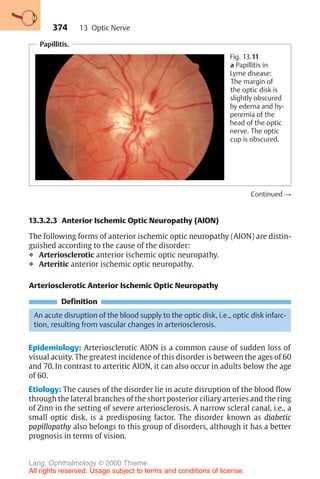 374
Papillitis.
Fig. 13.11
a Papillitis in
Lyme disease:
The margin of
the optic disk is
slightly obscured
by edema and hy-
peremia of the
head of the optic
nerve. The optic
cup is obscured.
Continued !
13.3.2.3 Anterior Ischemic Optic Neuropathy (AION)
The following forms of anterior ischemic optic neuropathy (AION) are distin-
guished according to the cause of the disorder:
❖ Arteriosclerotic anterior ischemic optic neuropathy.
❖ Arteritic anterior ischemic optic neuropathy.
Arteriosclerotic Anterior Ischemic Optic Neuropathy
Definition
An acute disruption of the blood supply to the optic disk, i.e., optic disk infarc-
tion, resulting from vascular changes in arteriosclerosis.
Epidemiology: Arteriosclerotic AION is a common cause of sudden loss of
visual acuity. The greatest incidence of this disorder is between the ages of 60
and 70. In contrast to arteritic AION, it can also occur in adults below the age
of 60.
Etiology: The causes of the disorder lie in acute disruption of the blood flow
through the lateral branches of the short posterior ciliary arteries and the ring
of Zinn in the setting of severe arteriosclerosis. A narrow scleral canal, i.e., a
small optic disk, is a predisposing factor. The disorder known as diabetic
papillopathy also belongs to this group of disorders, although it has a better
prognosis in terms of vision.
13 Optic Nerve
Lang, Ophthalmology © 2000 Thieme
All rights reserved. Usage subject to terms and conditions of license.
 