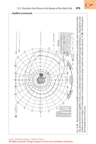 375
Papillitis (continued).
Fig.
13.11
b
Central
scotoma
in
papillitis:
A
central
scotoma
is
a
typical
functional
finding
in
retrobulbar
optic
neuritis
but
on
that
may
also
be
observed
in
papillitis.
In
this
case,
a
relative
scotoma
is
present
(indicated
by
single
hatching),
i.e.,
the
patient
is
only
unable
to
discern
markers
I/1
and
weaker
in
central
area
whereas
larger
markers
are
visible
(see
also
Fig.
13.10).
The
blind
spot
is
also
located
next
to
this
area.
13.3 Disorders that Obscure the Margin of the Optic Disk
Lang, Ophthalmology © 2000 Thieme
All rights reserved. Usage subject to terms and conditions of license.
 