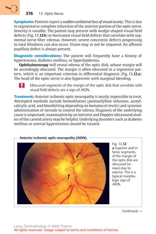 376
Symptoms: Patients report a sudden unilateral loss of visual acuity. This is due
to segmental or complete infarction of the anterior portion of the optic nerve.
Severity is variable. The patient may present with wedge-shaped visual field
defects (Fig. 13.12b) or horizontal visual field defects that correlate with seg-
mental nerve fiber edemas. However, severe concentric defects progressing
to total blindness can also occur. Vision may or not be impaired. An afferent
pupillary defect is always present.
Diagnostic considerations: The patient will frequently have a history of
hypertension, diabetes mellitus, or hyperlipidemia.
Ophthalmoscopy will reveal edema of the optic disk, whose margin will
be accordingly obscured. The margin is often obscured in a segmental pat-
tern, which is an important criterion in differential diagnosis (Fig. 13.12a).
The head of the optic nerve is also hyperemic with marginal bleeding.
Obscured segments of the margin of the optic disk that correlate with
visual field defects are a sign of AION.
Treatment: Anterior ischemic optic neuropathy is nearly impossible to treat.
Attempted methods include hemodilution (pentoxifylline infusions, acetyl-
salicylic acid, and bloodletting depending on hematocrit levels) and systemic
administration of steroids to control the edema. Diagnosis of the underlying
cause is important; examination by an internist and Doppler ultrasound stud-
ies of the carotid artery may be helpful. Underlying disorders such as diabetes
mellitus or arterial hypertension should be treated.
Anterior ischemic optic neuropathy (AION).
Fig. 13.12
a Superior and in-
ferior segments
of the margin of
the optic disk are
obscured (ar-
rows) due to
edema. This is a
typical morpho-
logic sign of
AION.
Continued !
13 Optic Nerve
Lang, Ophthalmology © 2000 Thieme
All rights reserved. Usage subject to terms and conditions of license.
 
