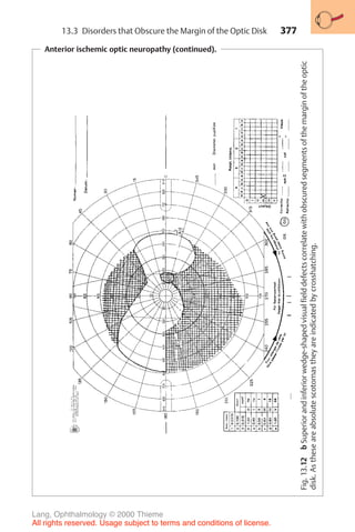 377
Anterior ischemic optic neuropathy (continued).
Fig.
13.12
b
Superior
and
inferior
wedge-shaped
visual
field
defects
correlate
with
obscured
segments
of
the
margin
of
the
optic
disk.
As
these
are
absolute
scotomas
they
are
indicated
by
crosshatching.
13.3 Disorders that Obscure the Margin of the Optic Disk
Lang, Ophthalmology © 2000 Thieme
All rights reserved. Usage subject to terms and conditions of license.
 