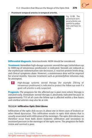 379
Prominent temporal arteries in temporal arteritis.
Fig. 13.13 The
prominent tem-
poral arteries are
painful to palpa-
tion and have no
pulse.
Differential diagnosis: Arteriosclerotic AION should be considered.
Treatment: Immediate high-dosage systemic steroid therapy (initial doses up
to 1000 mg of intravenous prednisone) is indicated. Steroids are reduced as
the erythrocyte sedimentation rate decreases, C-reactive protein levels drop,
and clinical symptoms abate. However, a maintenance dose will be required
for several months. Vascular treatment such as pentoxifylline infusions may
be attempted.
High-dosage systemic steroid therapy (for example 250 mg of
intravenous prednisone) is indicated to protect the fellow eye even if a
giant cell arteritis is only suspected.
Prognosis: The prognosis for the affected eye is poor even where therapy is
initiated early. Immediate steroid therapy is absolutely indicated because in
approximately 75% of all cases the fellow eye is affected within a few hours
and cerebral arteries may also be at risk.
13.3.2.4 Infiltrative Optic Disk Edema
Infiltration of the optic disk occurs in about one in three cases of leukosis or
other blood dyscrasias. This infiltration results in optic disk edema that is
usually associated with infiltration of the meninges. The optic disk edema can
therefore occur from both direct leukemic infiltration and secondary to
increased pressure in the meninges of the optic nerve. The prognosis for both
vision and survival is poor.
13.3 Disorders that Obscure the Margin of the Optic Disk
Lang, Ophthalmology © 2000 Thieme
All rights reserved. Usage subject to terms and conditions of license.
 