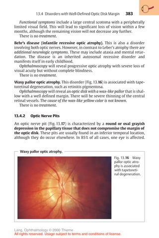 383
Functional symptoms include a large central scotoma with a peripherally
limited visual field. This will lead to significant loss of vision within a few
months, although the remaining vision will not decrease any further.
There is no treatment.
Behr’s disease (infantile recessive optic atrophy). This is also a disorder
involving both optic nerves. However, in contrast to Leber’s atrophy there are
additional neurologic symptoms. These may include ataxia and mental retar-
dation. The disease is an inherited autosomal recessive disorder and
manifests itself in early childhood.
Ophthalmoscopy will reveal progressive optic atrophy with severe loss of
visual acuity but without complete blindness.
There is no treatment.
Waxy pallor optic atrophy. This disorder (Fig. 13.16) is associated with tape-
toretinal degeneration, such as retinitis pigmentosa.
Ophthalmoscopy will reveal an optic disk with a wax-like pallor that is shal-
low with a well defined margin. There will be severe thinning of the central
retinal vessels. The cause of the wax-like yellow color is not known.
There is no treatment.
13.4.2 Optic Nerve Pits
An optic nerve pit (Fig. 13.17) is characterized by a round or oval grayish
depression in the papillary tissue that does not compromise the margin of
the optic disk. These pits are usually found in an inferior temporal location,
although they do occur elsewhere. In 85% of all cases, one eye is affected.
Waxy pallor optic atrophy.
Fig. 13.16 Waxy
pallor optic atro-
phy is associated
with tapetoreti-
nal degeneration.
13.4 Disorders with Well-Defined Optic Disk Margin
Lang, Ophthalmology © 2000 Thieme
All rights reserved. Usage subject to terms and conditions of license.
 