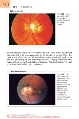 384
Optic nerve pits.
Fig. 13.17 These
are oval grayish
temporal depres-
sions in the papil-
lary tissue
(arrow).
Several pits in one optic disk have been described. Serous retinal detachment
occurs in 25% of all cases, depending on the location of the pit. Where the
detachment affects the macula, a significant loss of visual acuity will result
that will prove very difficult to manage with laser surgery. Otherwise optic
nerve pits are an incidental finding without any functional deficit. They are
considered to be rudimentary colobomas.
Optic disk coloboma.
Fig. 13.18 The
optic disk is en-
larged with a fun-
nel-shaped de-
pression with
whitish tissue and
a peripapillary
pigment ring.
The retinal ves-
sels do not
branch from a
central venous or
arterial trunk.
13 Optic Nerve
Lang, Ophthalmology © 2000 Thieme
All rights reserved. Usage subject to terms and conditions of license.
 