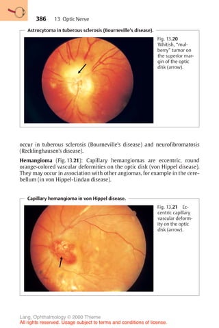 386
Astrocytoma in tuberous sclerosis (Bourneville’s disease).
Fig. 13.20
Whitish, “mul-
berry” tumor on
the superior mar-
gin of the optic
disk (arrow).
Capillary hemangioma in von Hippel disease.
Fig. 13.21 Ec-
centric capillary
vascular deform-
ity on the optic
disk (arrow).
occur in tuberous sclerosis (Bourneville’s disease) and neurofibromatosis
(Recklinghausen’s disease).
Hemangioma (Fig. 13.21): Capillary hemangiomas are eccentric, round
orange-colored vascular deformities on the optic disk (von Hippel disease).
They may occur in association with other angiomas, for example in the cere-
bellum (in von Hippel-Lindau disease).
13 Optic Nerve
Lang, Ophthalmology © 2000 Thieme
All rights reserved. Usage subject to terms and conditions of license.
 