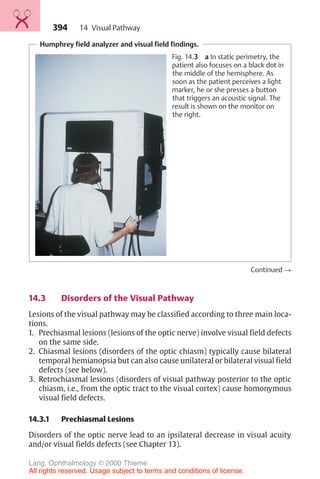 394
Humphrey field analyzer and visual field findings.
Fig. 14.3 a In static perimetry, the
patient also focuses on a black dot in
the middle of the hemisphere. As
soon as the patient perceives a light
marker, he or she presses a button
that triggers an acoustic signal. The
result is shown on the monitor on
the right.
Continued !
14.3 Disorders of the Visual Pathway
Lesions of the visual pathway may be classified according to three main loca-
tions.
1. Prechiasmal lesions (lesions of the optic nerve) involve visual field defects
on the same side.
2. Chiasmal lesions (disorders of the optic chiasm) typically cause bilateral
temporal hemianopsia but can also cause unilateral or bilateral visual field
defects (see below).
3. Retrochiasmal lesions (disorders of visual pathway posterior to the optic
chiasm, i.e., from the optic tract to the visual cortex) cause homonymous
visual field defects.
14.3.1 Prechiasmal Lesions
Disorders of the optic nerve lead to an ipsilateral decrease in visual acuity
and/or visual fields defects (see Chapter 13).
14 Visual Pathway
Lang, Ophthalmology © 2000 Thieme
All rights reserved. Usage subject to terms and conditions of license.
 