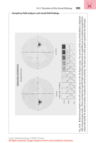 395
Humphrey field analyzer and visual field findings.
Fig.
14.3
b
Normal
visual
field
in
the
left
and
right
eyes
in
the
30
degree
range.
The
severity
of
the
visual
field
defect
is
depicted
with
increasing
gray
scales.
These
correspond
to
specific
light
intensities
(ASB
stands
for
apostilb)
and
are
graphed
as
logarithmic
values
(DB
stands
for
decibel)
to
better
visualize
the
retinal
sensitivity.
The
dark
area
in
both
graphs
represents
the
blind
spot.
14.3 Disorders of the Visual Pathway
Lang, Ophthalmology © 2000 Thieme
All rights reserved. Usage subject to terms and conditions of license.
 