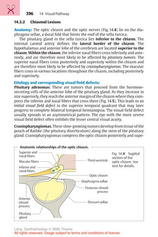 396
14.3.2 Chiasmal Lesions
Anatomy: The optic chiasm and the optic nerves (Fig. 14.4) lie on the dia-
phragma sellae, a dural fold that forms the roof of the sella turcica.
The pituitary gland in the sella turcica lies inferior to the chiasm. The
internal carotid artery defines the lateral border of the chiasm. The
hypothalamus and anterior lobe of the cerebrum are located superior to the
chiasm. Within the chiasm, the inferior nasal fibers cross inferiorly and ante-
riorly, and are therefore most likely to be affected by pituitary tumors. The
superior nasal fibers cross posteriorly and superiorly within the chiasm and
are therefore most likely to be affected by craniopharyngiomas. The macular
fibers cross in various locations throughout the chiasm, including posteriorly
and superiorly.
Etiology and corresponding visual field defects:
Pituitary adenomas: These are tumors that proceed from the hormone-
secreting cells of the anterior lobe of the pituitary gland. As they increase in
size superiorly, they reach the anterior margin of the chiasm where they com-
press the inferior and nasal fibers that cross there (Fig. 14.5). This leads to an
initial visual field defect in the superior temporal quadrant that may later
progress to complete bilateral temporal hemianopsia. The visual field defect
usually spreads in an asymmetrical pattern. The eye with the more severe
visual field defect often exhibits the lesser central visual acuity.
Craniopharyngiomas. These slow-growing tumors develop from tissue of the
pouch of Rathke (the pituitary diverticulum) along the stem of the pituitary
gland. Craniopharyngiomas compress the optic chiasm posteriorly and supe-
Anatomic relationships of the optic chiasm.
Superior and
nasal fibers
Macular fibers
Inferior and
nasal fibers
Anterior
clinoid
process
Pituitary
gland
Third ventricle
Optic chiasm
Diaphragma sellae
Dorsum sellae
Posterior clinoid
process
Fig. 14.4 Sagittal
section of the
optic chiasm. See
text for details.
14 Visual Pathway
Lang, Ophthalmology © 2000 Thieme
All rights reserved. Usage subject to terms and conditions of license.
 