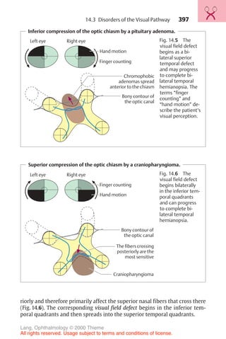 397
riorly and therefore primarily affect the superior nasal fibers that cross there
(Fig. 14.6). The corresponding visual field defect begins in the inferior tem-
poral quadrants and then spreads into the superior temporal quadrants.
Inferior compression of the optic chiasm by a pituitary adenoma.
Left eye Right eye
Hand motion
Finger counting
Chromophobic
adenomas spread
anterior to the chiasm
Bony contour of
the optic canal
Fig. 14.5 The
visual field defect
begins as a bi-
lateral superior
temporal defect
and may progress
to complete bi-
lateral temporal
hemianopsia. The
terms “finger
counting” and
“hand motion” de-
scribe the patient’s
visual perception.
Superior compression of the optic chiasm by a craniopharyngioma.
Left eye Right eye
Hand motion
Finger counting
The fibers crossing
posteriorly are the
most sensitive
Craniopharyngioma
Bony contour of
the optic canal
Fig. 14.6 The
visual field defect
begins bilaterally
in the inferior tem-
poral quadrants
and can progress
to complete bi-
lateral temporal
hemianopsia.
14.3 Disorders of the Visual Pathway
Lang, Ophthalmology © 2000 Thieme
All rights reserved. Usage subject to terms and conditions of license.
 