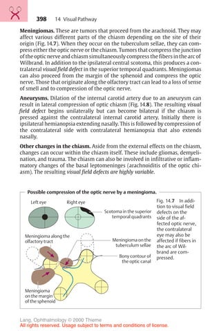 398
Meningiomas. These are tumors that proceed from the arachnoid. They may
affect various different parts of the chiasm depending on the site of their
origin (Fig. 14.7). When they occur on the tuberculum sellae, they can com-
press either the optic nerve or the chiasm. Tumors that compress the junction
of the optic nerve and chiasm simultaneously compress the fibers in the arc of
Wilbrand. In addition to the ipsilateral central scotoma, this produces a con-
tralateral visual field defect in the superior temporal quadrants. Meningiomas
can also proceed from the margin of the sphenoid and compress the optic
nerve. Those that originate along the olfactory tract can lead to a loss of sense
of smell and to compression of the optic nerve.
Aneurysms. Dilation of the internal carotid artery due to an aneurysm can
result in lateral compression of optic chiasm (Fig. 14.8). The resulting visual
field defect begins unilaterally but can become bilateral if the chiasm is
pressed against the contralateral internal carotid artery. Initially there is
ipsilateral hemianopsia extending nasally. This is followed by compression of
the contralateral side with contralateral hemianopsia that also extends
nasally.
Other changes in the chiasm. Aside from the external effects on the chiasm,
changes can occur within the chiasm itself. These include gliomas, demyeli-
nation, and trauma. The chiasm can also be involved in infiltrative or inflam-
matory changes of the basal leptomeninges (arachnoiditis of the optic chi-
asm). The resulting visual field defects are highly variable.
Possible compression of the optic nerve by a meningioma.
Left eye Right eye
Scotoma in the superior
temporal quadrants
Meningioma along the
olfactory tract
Bony contour of
the optic canal
Meningioma
on the margin
of the sphenoid
Meningioma on the
tuberculum sellae
Fig. 14.7 In addi-
tion to visual field
defects on the
side of the af-
fected optic nerve,
the contralateral
eye may also be
affected if fibers in
the arc of Wil-
brand are com-
pressed.
14 Visual Pathway
Lang, Ophthalmology © 2000 Thieme
All rights reserved. Usage subject to terms and conditions of license.
 