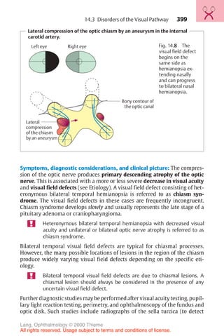 399
Lateral compression of the optic chiasm by an aneurysm in the internal
carotid artery.
Left eye Right eye
Bony contour of
the optic canal
Lateral
compression
of the chiasm
by an aneurysm
Fig. 14.8 The
visual field defect
begins on the
same side as
hemianopsia ex-
tending nasally
and can progress
to bilateral nasal
hemianopsia.
Symptoms, diagnostic considerations, and clinical picture: The compres-
sion of the optic nerve produces primary descending atrophy of the optic
nerve. This is associated with a more or less severe decrease in visual acuity
and visual field defects (see Etiology). A visual field defect consisting of het-
eronymous bilateral temporal hemianopsia is referred to as chiasm syn-
drome. The visual field defects in these cases are frequently incongruent.
Chiasm syndrome develops slowly and usually represents the late stage of a
pituitary adenoma or craniopharyngioma.
Heteronymous bilateral temporal hemianopsia with decreased visual
acuity and unilateral or bilateral optic nerve atrophy is referred to as
chiasm syndrome.
Bilateral temporal visual field defects are typical for chiasmal processes.
However, the many possible locations of lesions in the region of the chiasm
produce widely varying visual field defects depending on the specific eti-
ology.
Bilateral temporal visual field defects are due to chiasmal lesions. A
chiasmal lesion should always be considered in the presence of any
uncertain visual field defect.
Further diagnostic studies may be performed after visual acuity testing, pupil-
lary light reaction testing, perimetry, and ophthalmoscopy of the fundus and
optic disk. Such studies include radiographs of the sella turcica (to detect
14.3 Disorders of the Visual Pathway
Lang, Ophthalmology © 2000 Thieme
All rights reserved. Usage subject to terms and conditions of license.
 