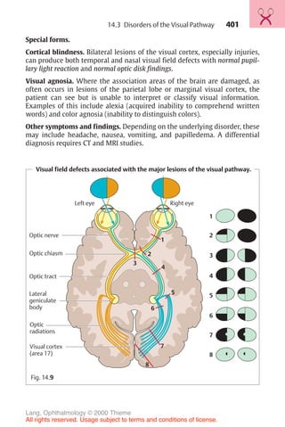 401
Special forms.
Cortical blindness. Bilateral lesions of the visual cortex, especially injuries,
can produce both temporal and nasal visual field defects with normal pupil-
lary light reaction and normal optic disk findings.
Visual agnosia. Where the association areas of the brain are damaged, as
often occurs in lesions of the parietal lobe or marginal visual cortex, the
patient can see but is unable to interpret or classify visual information.
Examples of this include alexia (acquired inability to comprehend written
words) and color agnosia (inability to distinguish colors).
Other symptoms and findings. Depending on the underlying disorder, these
may include headache, nausea, vomiting, and papilledema. A differential
diagnosis requires CT and MRI studies.
Visual field defects associated with the major lesions of the visual pathway.
Optic chiasm
Optic tract
Lateral
geniculate
body
Optic nerve
Visual cortex
(area 17)
1
2
3
4
5
6
7
8
1
2
3
4
5
6
7
8
Left eye Right eye
Optic
radiations
Fig. 14.9
14.3 Disorders of the Visual Pathway
Lang, Ophthalmology © 2000 Thieme
All rights reserved. Usage subject to terms and conditions of license.
 
