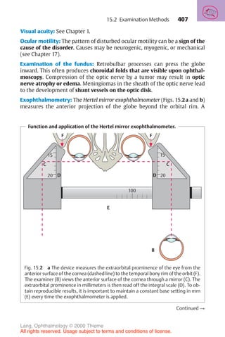407
Visual acuity: See Chapter 1.
Ocular motility: The pattern of disturbed ocular motility can be a sign of the
cause of the disorder. Causes may be neurogenic, myogenic, or mechanical
(see Chapter 17).
Examination of the fundus: Retrobulbar processes can press the globe
inward. This often produces choroidal folds that are visible upon ophthal-
moscopy. Compression of the optic nerve by a tumor may result in optic
nerve atrophy or edema. Meningiomas in the sheath of the optic nerve lead
to the development of shunt vessels on the optic disk.
Exophthalmometry: The Hertel mirror exophthalmometer (Figs. 15.2a and b)
measures the anterior projection of the globe beyond the orbital rim. A
Function and application of the Hertel mirror exophthalmometer.
15
d 20
c
15
d
20
c
100
15
20
C
15
D
20
100
C
D
F
F
E
B
E
B
Fig. 15.2 a The device measures the extraorbital prominence of the eye from the
anterior surface of the cornea (dashed line) to the temporal bony rim of the orbit (F).
The examiner (B) views the anterior surface of the cornea through a mirror (C). The
extraorbital prominence in millimeters is then read off the integral scale (D). To ob-
tain reproducible results, it is important to maintain a constant base setting in mm
(E) every time the exophthalmometer is applied.
Continued !
15.2 Examination Methods
Lang, Ophthalmology © 2000 Thieme
All rights reserved. Usage subject to terms and conditions of license.
 